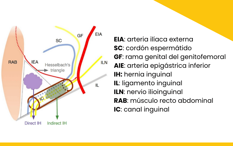 1. Hernia inguinal indirecta ecografia tempo formacion.png